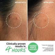 The INKEY List Hydrocolloid Invisible Pimple Patches (22 patches)